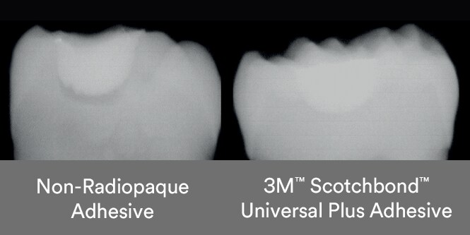 Comparison of non-radiopaque adhesive shadow and radiopaque Scotchbond Universal Plus Adhesive
