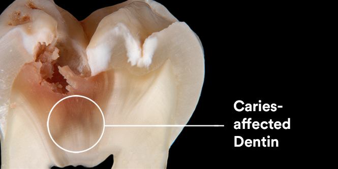 Cross-section of tooth with caries-affected dentin
